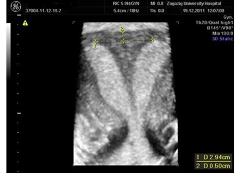 Bicornuate Uterus Causes Symptoms Ultrasound