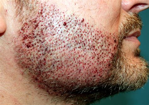 Some prospective candidates may seek care elsewhere for a higher fee believing they are getting a better product. How Can Beard Hair Transplant In Ludhiana Can Change The ...