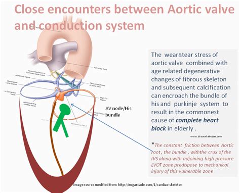 Anatomical Encounters Of Aortic Valve With Bundle Of His An