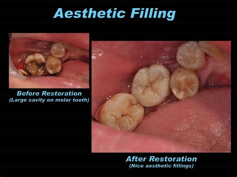 Prestige Dental Care: Aesthetic Filling