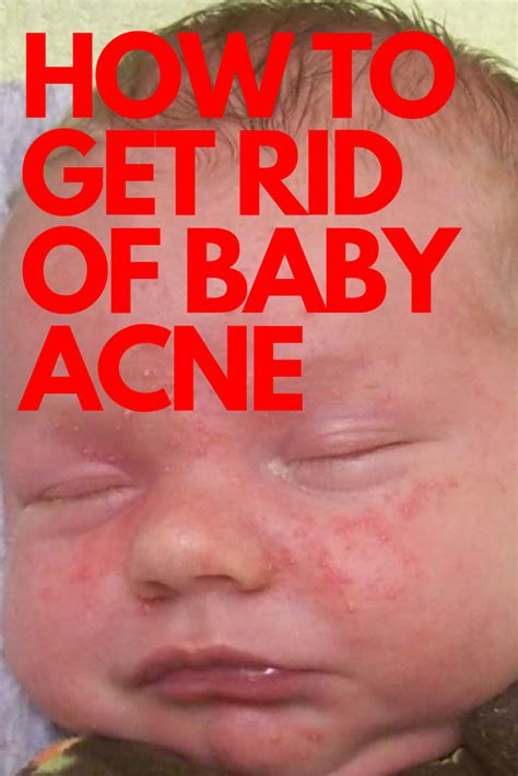 How To Get Rid Of Baby Acne Baby Acne Newborn Acne Soothing Baby