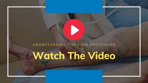 Evlt Minimally Invasive Surgery For Varicose Veins Youtube