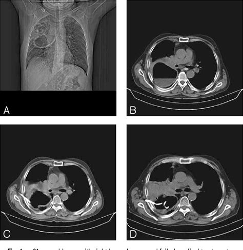 Figure From Ct Guided Percutaneous Drainage Of Lung Abscesses Review