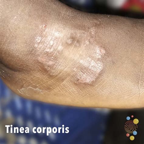 Tinea Corporis Skin Deep