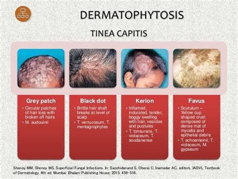 Varieties Of Tinea Capitis Medizzy