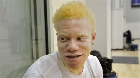 Is there any ethnic Somali albinos? | Somali Spot | Forum, News, Videos