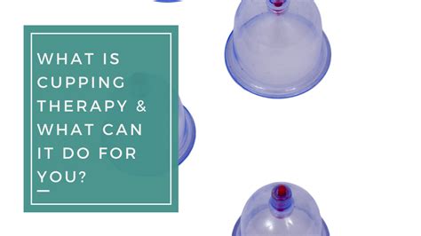 What Is Cupping Therapy And What Can It Do For You