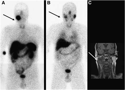 Mibg Negative Paraganglioma A And B Srs Image A Shows Pathologic