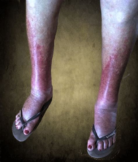 Cutaneous Purpuric Rash And Edema Of The Ankles And Feet Case Courtesy