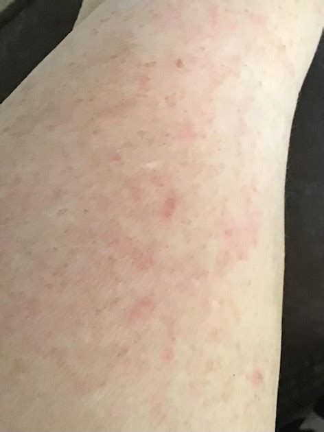 Mysterious Rash I Be Suddenly Had A Rash Come Up Lupus Uk