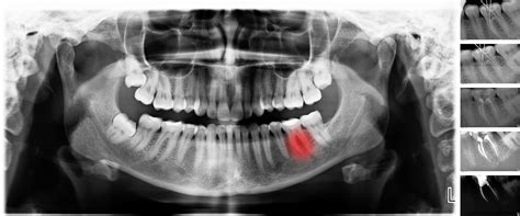 tooth sensitivity after a filling causes symptoms and treatment