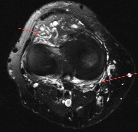 Soft Tissue Hemangioma The Most Frequent Tumor Of Infancy And