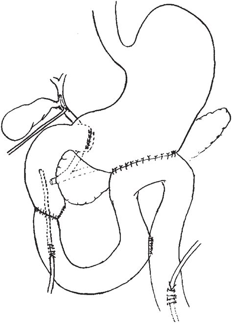 Repair Of The Injury Was Done With Primary Duodenojejunostomy Pyloric