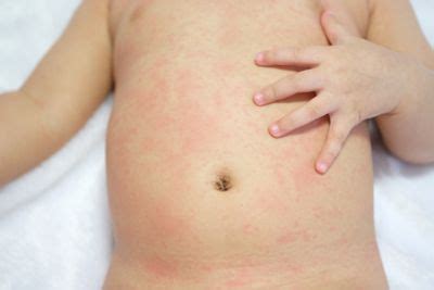 Symptoms And Treatments Of Scarlet Fever Facty Health