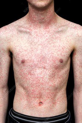 Rash From Drug Allergy Stock Image M Science Photo Library My Xxx Hot