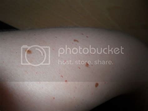 Tiny Pin Prick Red Blood Spots On Skin The Student Room