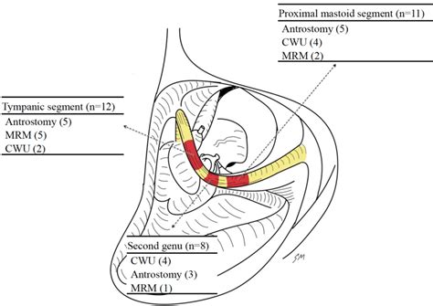 The Incidence And Site Of Facial Nerve Injuries Cwu Canal Wall Up Download Scientific Diagram