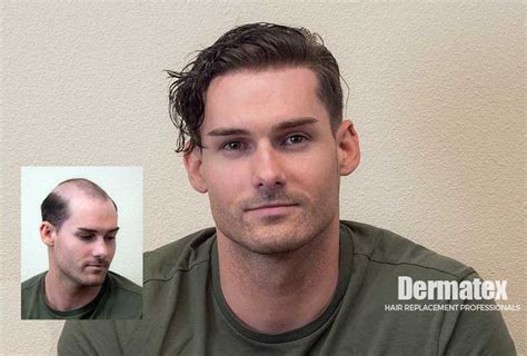 Unlike other hair replacement solutions for men, lordhair's hair systems guarantee results with 100% realistic look. Men's Non-Surgical Hair Replacement Gallery - Shane ...
