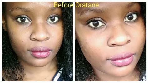 Permanent Acne Solution Accutane Oratane Treatment Month Of Oratane Accutane