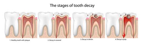 The 5 Stages Of Tooth Decay News Dentagama