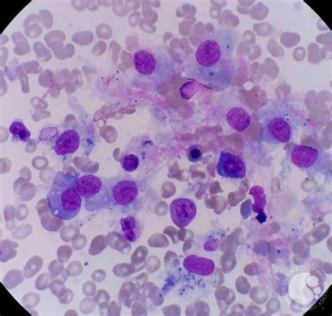 Histiocytes In Normal Bone Marrow