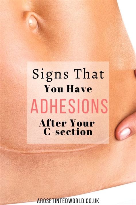 Adhesions After A C Section ⋆ A Rose Tinted World