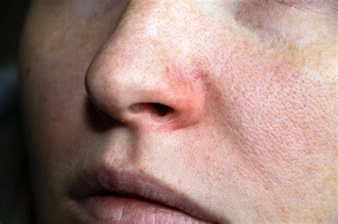 Аллергия на лице фото Большая подборка фотографий аллергических