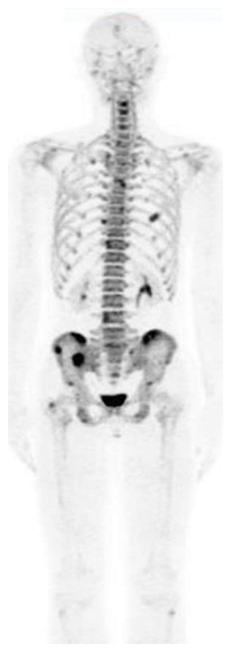 A 31 Year Old Man With Npc Planar 99mtc Mdp Bone Scintigraphy Shows