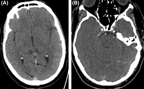 A Noncontrast Enhanced Ct Shows Subarachnoid Hemorrhage In Left