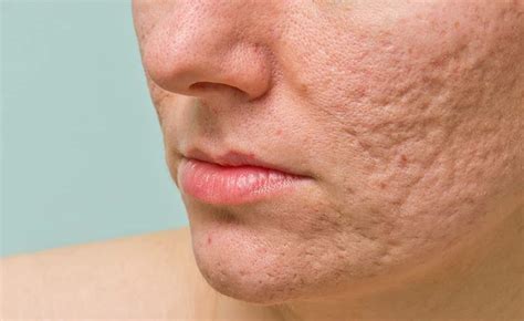 Acne Scarring Treatments At Venus Medical