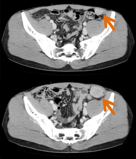 Abdominal Ct Scans The Growing Tumor Of Left Lower Abdomen One Year