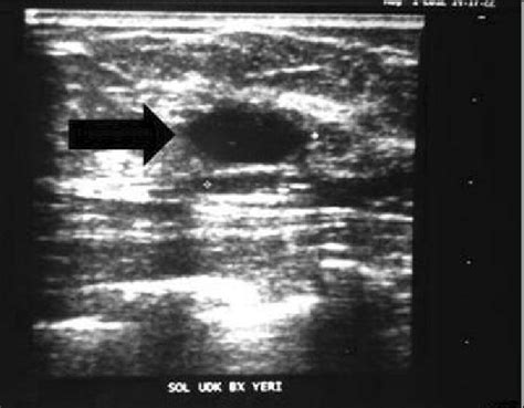 Ultrasonography Of Breast Shows A Heterogeneous Hypoechoic Mass