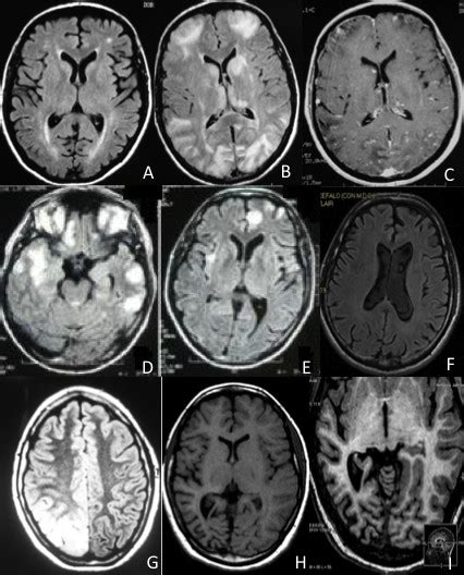 Brain Mri In Our Series A Patient 1 At Entry Hyperintense Spots In
