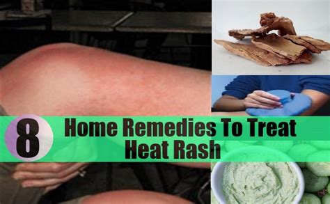 8 Excellent Home Remedies To Treat Heat Rash Natural Treatments And