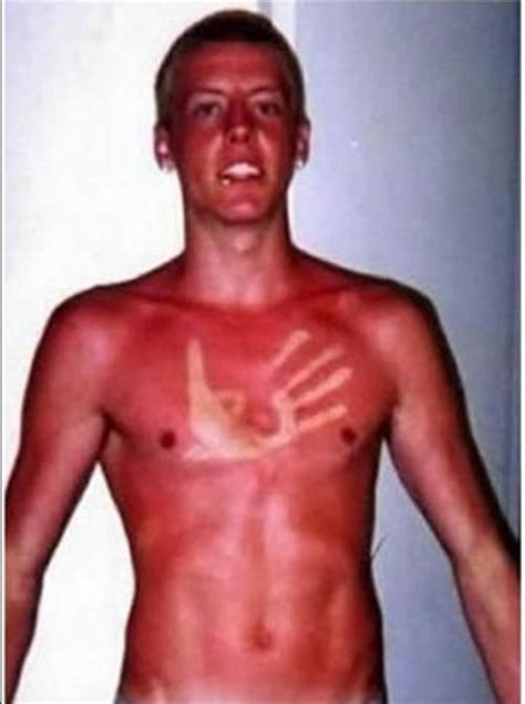 People Living With The World S Most Awkward Sun Tan Line Fails Ever