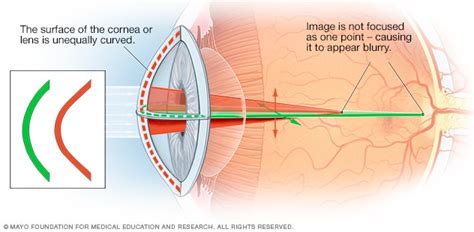 Astigmatism Symptoms And Causes Mayo Clinic