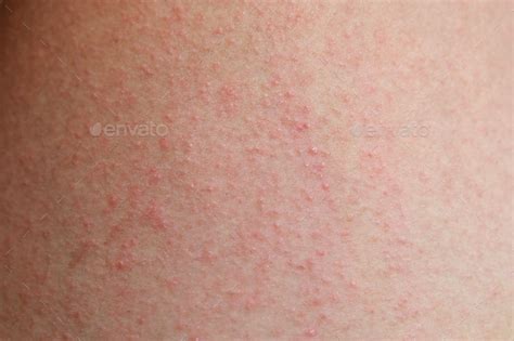 Allergic Rash Dermatitis Skin Of Patient Stock Image Everypixel