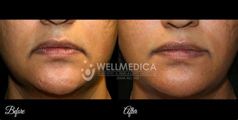 Bellafill Is An Injectable Wrinkle Filler That Provides Long Lasting