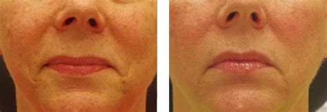 Ipl Photofacial Ipl Laser Treatment Us Dermatology Partners