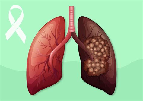 Lung Cancer Symptoms Causes Stages And Treatment Vrogue Co