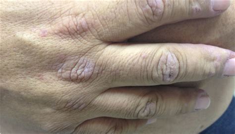 Derm Dx Itchy Rash On Eyelids Chest Back And Hands Clinical Advisor