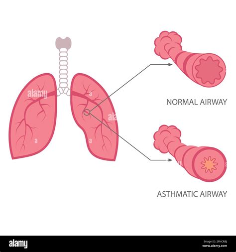 Vector Asthma Illustration Bronchial Lungs Respiratory Disease Stock