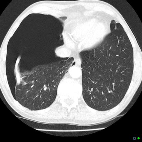 Spontaneous Pneumothorax Due To Ruptured Apical Bullae Image