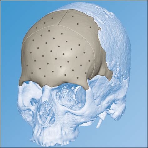 Peek Cranial Implant Milled Implant Depuy Synthes