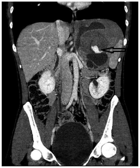 Sporadic Giant Intra Abdominal Desmoid Tumor A Radiological Case Report