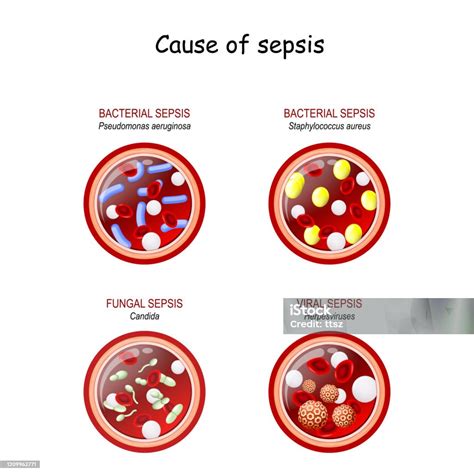 Cause Of Sepsis Stock Illustration Download Image Now Sepsis