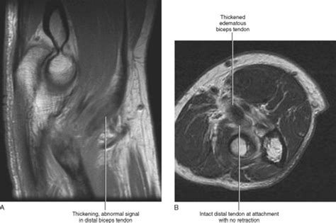 Imaging Of The Elbow Radiology Key