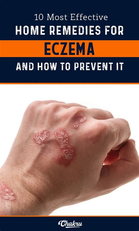 Best Home Remedies For Eczema And How To Prevent It