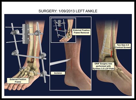 Seibert fj (2003) external fixation in trauma of the foot and ankle. External Fixation and Ankle Plate - 3D Justice, LLC3D ...