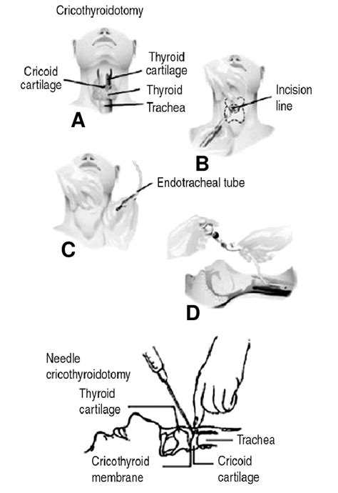 Cricothyroidotomy Anatomy